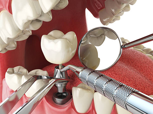 Best Broken or Cracked Tooth Emergency Dentist in Whitesboro, NY